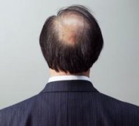脱发的危害是什么呢