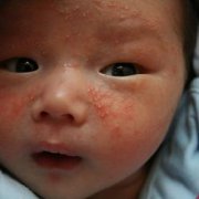 婴儿湿疹的护理