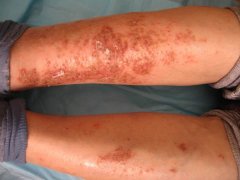 湿疹的预防要点是什么