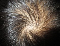 患上脱发的影响有哪些呢